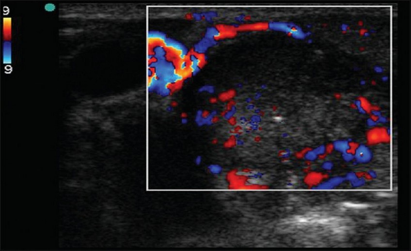 Peripheral Color Doppler Sujata Birla Hospital