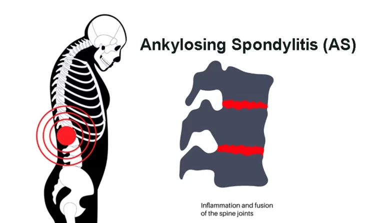 Ankylosing Spondylitis (AS)